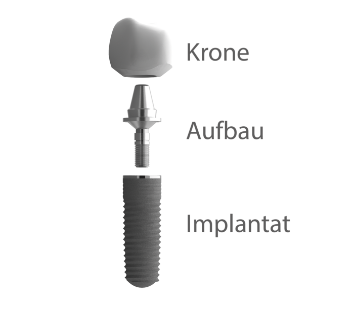 Implantataufbau, Krone, Aufbau, Implantat