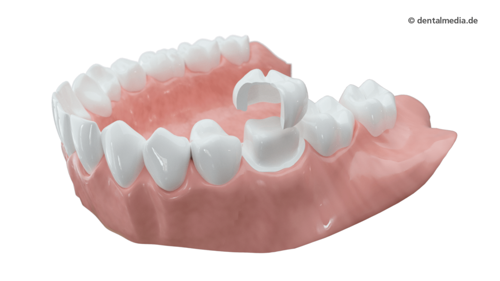 Zahnkrone — Zahnarztpraxis in Gelsenkirchen