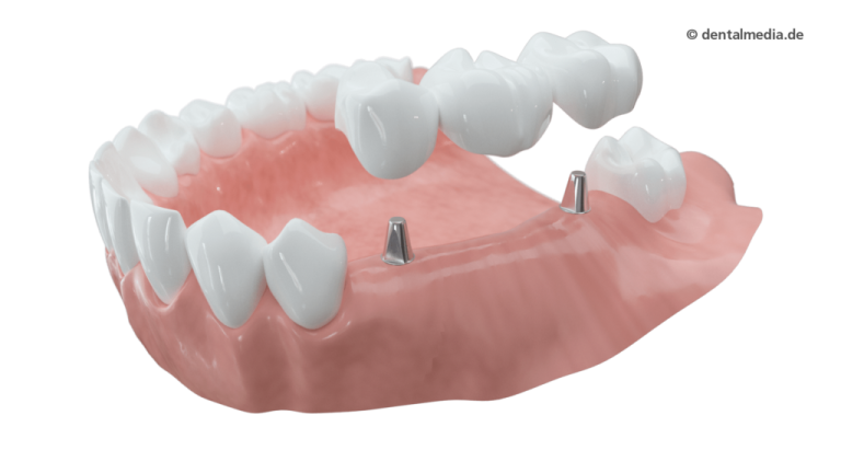 Schaltlücke mehrfachlück-Brücke mit Implantat