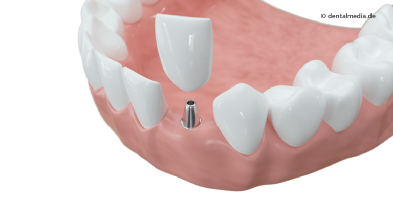 Schaltlücke mit Implantat und Zahn